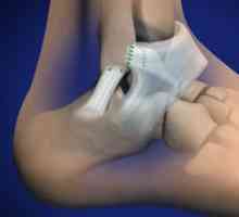 Istezanje ligamenata stopala - simptomi i liječenje