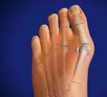 Raste kost u stopalu: uzroci, simptomi, tretman