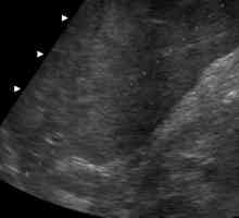 Dimenzije normalni ultrazvuk jetre (transkript)