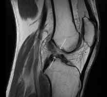 Rupture prednjeg križnog ligamenta: zašto se to dešava i kako to popraviti?
