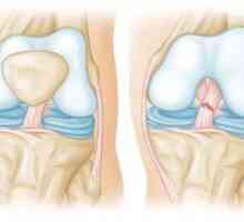 Rupture ligamenata kolena