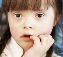 Dijete down - šta to znači? Znaci i simptomi Downovog sindroma