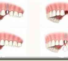Restauracija zuba: kada i kako primijeniti postupak?