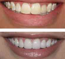 Restauracija zuba prije i poslije. Narativni stomatološke restauracije