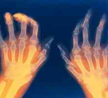 Reumatoidni artritis: simptomi i tretman pravnih lijekova droge i narodne