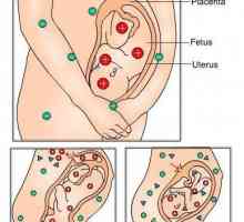 Rezus-sukob majke i fetusa tokom trudnoće: sto. Imuni sukob majke i fetusa