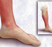 Erysipelas na nozi (noge erysipelas). Tretman: folk lijekova. Erysipelas noge: Simptomi i tretman…