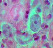 Najčešći protozoama infekcija