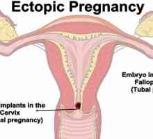 Cervikalne trudnoće: uzroci, simptomi, dijagnoza