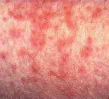 Simptomi citomegalovirusom infekcije i dijagnoza