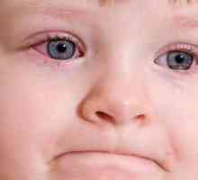 Simptomi i liječenje konjuktivitisa kod djeteta