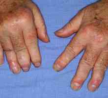 Simptomi i tretman Psorijazni artritis