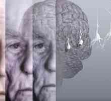 Demencije sindrom ili demencije
