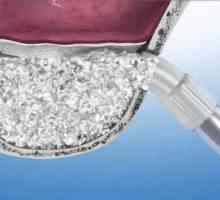 Sinus lift: koristiti u dentalnih implantata. Vrste, indikacije, moguće komplikacije