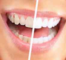 Zubi izbjeljivanje Global White: recenzije. Global White: prednosti i mane