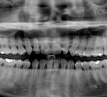 Koliko kanala u zubu gornje i donje vilice?