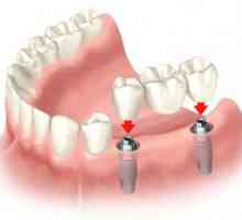 Koliko je implantacija jedan zub u modernim bolnicama
