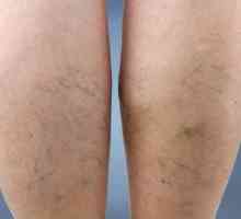 Vaskularne neto na noge: kako riješi uzroke i karakteristike liječenja