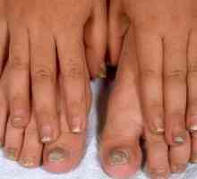 Sredstva iz noktiju gljivica na nogama: prevenciju i liječenje