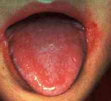 Stomatitis u djece: Simptomi i tretman