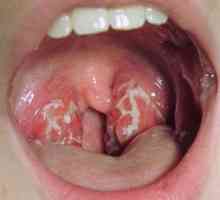 Streptokoka u grlu: simptomi, uzroci i liječenje