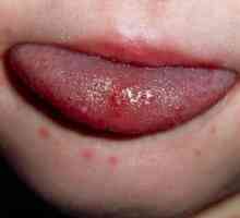 Osip na usta djeteta: ono bolesti uzrok?