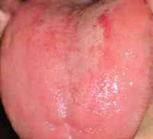 Pip jezik - uzroci, simptomi i tretman