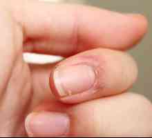 Ispucale kože na prstima oko noktiju: uzroci i liječenje. Ispucale kože na prstima