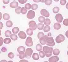 Trombocitopenija u trudnoći: uzroci, posljedice, tretman