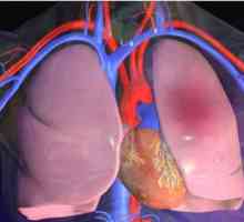 Tromboembolije malih grana plućne arterije: uzroci, simptomi i dijagnoza