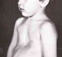 Dijete ima grudi deformitet: Uzroci patologije i liječenja metode