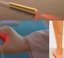 Vein laser uklanjanje: mišljenja, posljedice i rehabilitaciju