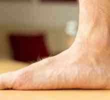 Vježbe za ravna stopala. Ortopedski ulošci za ravne noge