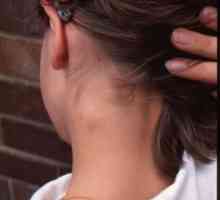 Uvećani limfni čvor na vratu kod djece. Šta to znači?