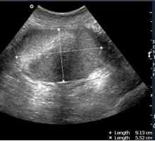 Ginekološki ultrazvuk kada učiniti: prije ili poslije menstruacije?
