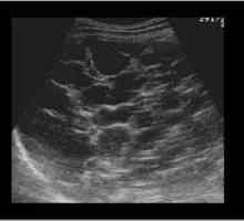 Ultrazvuk jetre: transkript pravilo. Dimenzije jetre: normalnog odraslog