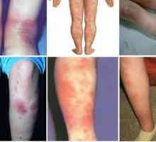 Eritem nodosum na nogama: simptomi, uzroci, liječenje
