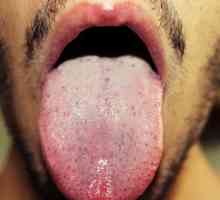 Saznajte šta je uzrok bijele mrlje na jeziku odraslih