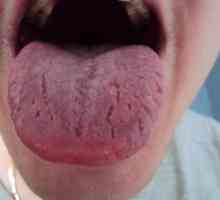 Koji su uzroci spaljivanja jezik