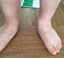 Valgus stopala na bebu: uzroci, liječenje. Ortopedske dječje cipele