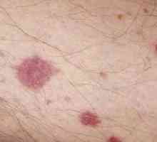 Vaskulitis - lezije zidova krvnih sudova
