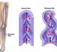 Venotoniki noge s proširenim venama: opis proizvoda