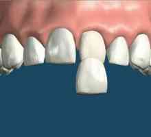 Furnir o prednostima zubima element, odlike njegova instalacija i indikacije za upotrebu