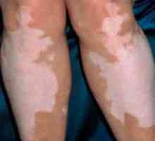 "Vitiks" (gel i tablete) za liječenje vitiliga: uputstva za upotrebu