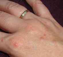 Vodenaste plikove na prstima: simptomi i liječenje