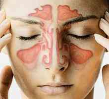 Upala sinusa, ili Što je sinusitis