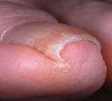 Urasta tretman noktiju i prevenciju