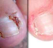 Urasta nokat na nozi: uzroci i liječenje
