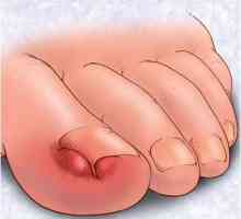 Urasle nokte na nogama: uzroci, simptomi, liječenje