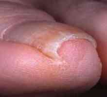 Uraslih noktiju: kućno liječenje moguće?